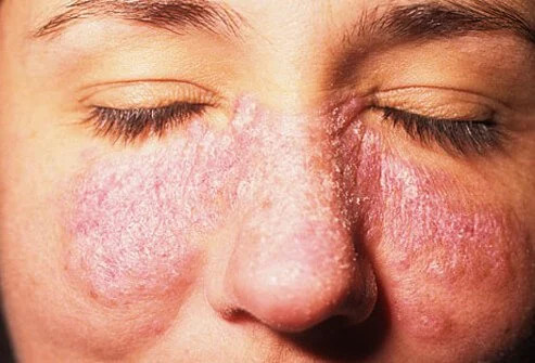 Lupus Eritematosus Kulit